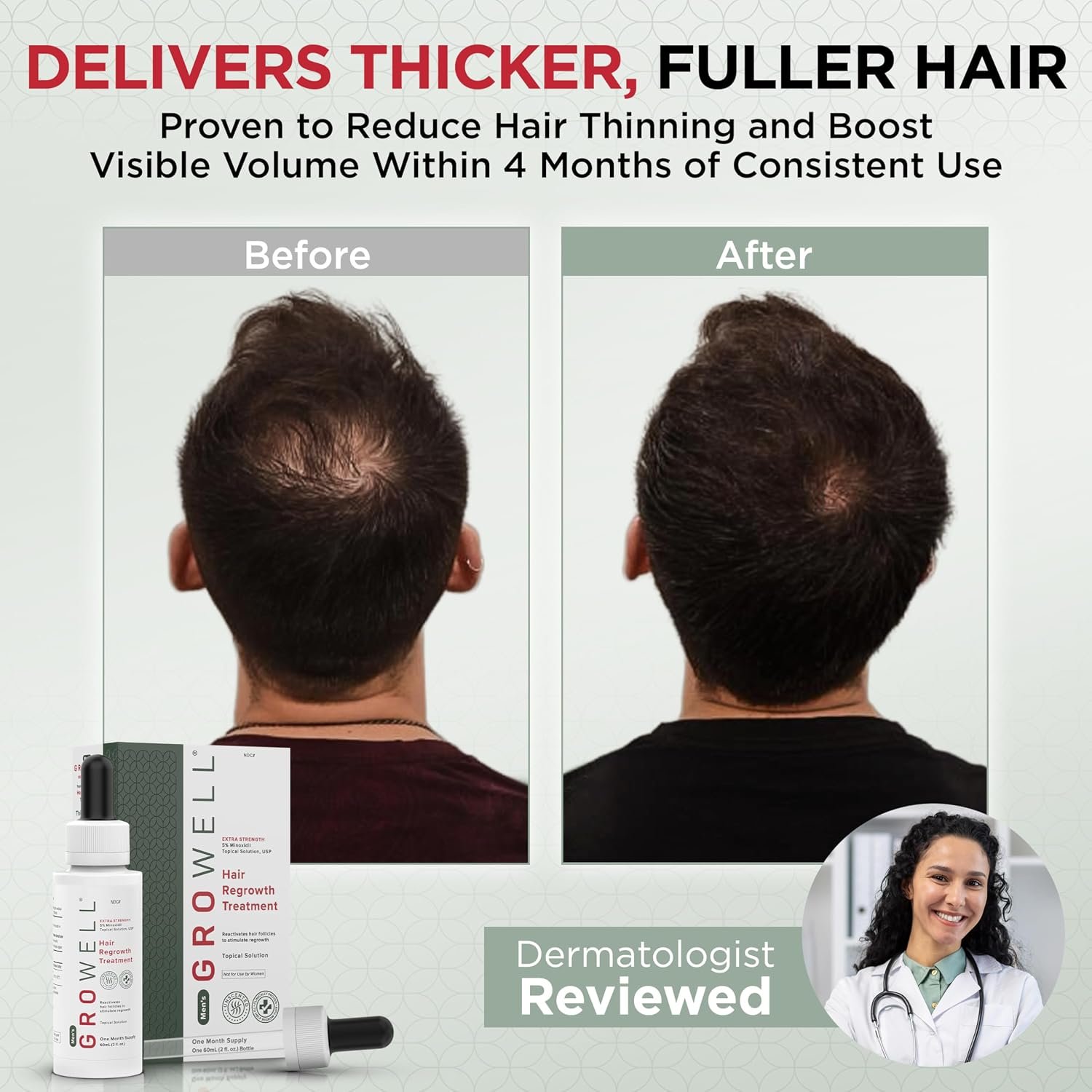 Topical minoxidil for men applied to scalp with dropper — before/after